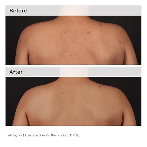 Miniatura 6 de The Ordinary Suero corporal de ácido salicílico al 0.5%, tratamiento exfoliante para piel propensa al acné, 8.1 onzas líquidas