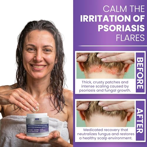 Rida Hair Research Institute Anti Fungal Scrub for Men & Women | Anti Dandruff, Medicated, Folliculitis Scrub for Dry Scalp, Psoriasis, Ringworm | for Itchy, Flaky & Irritated Scalp
