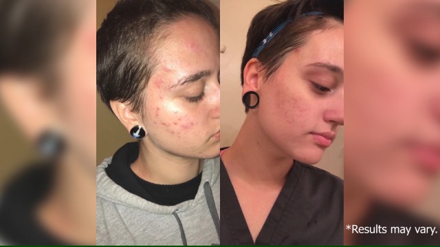 6 PanOxyl+Benzoyl+Peroxide+Control+Antimicrobial