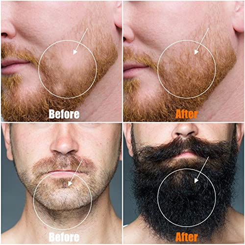 Beard Roller For Patchy Beard Growth, Beard Derma Roller Microneedle Roller Beard Growth Kit 0.25Mm For Men Mustache Facial Hair Growth 2 Packs #TOP5