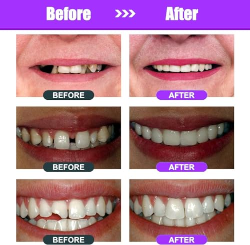 Image of Tooth Repair Kit, Moldable Tooth Filling Repair Kit, Fake Teeth DIY at Home, Fixing Missing & Broken Tooth Replacements, with 4 Dental Tools