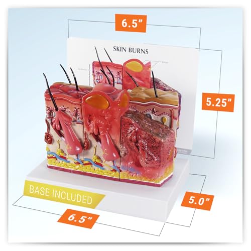 Image of GPI Anatomicals Skin Burn Model, Cross-Section Model Showing Burnt Skin | Human Body and Anatomy Replica for Physiology Education, Anatomical Model for Doctor's Office, Medical Learning Resources