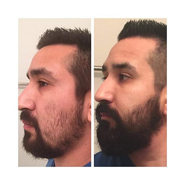 Beard Growth Kit, VIKICON Bartpflege Set, Bartwachstum Kit für Männer, Bart Derma Roller Bartwachstum Serum Öl Bart… – Bild 5