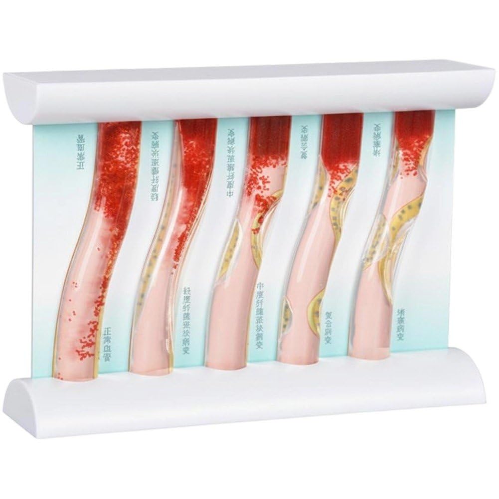 Fituenly Blood Vessel Model Anatomical Teaching, Simulated Artery Hyperlipidemia Comparison, Dynamic Blood Flow Blockage Model for Educational Demonstration