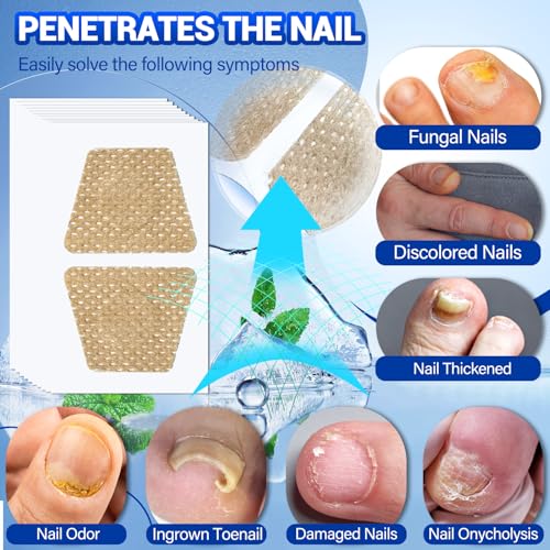 Toenail Fungus Treatment - 50Pcs Fungal Nail Patches Extra Strength with Hydrogel for Overnight Repair Nail Fungus Patches, Not Easy to Fall Off Toenail Corrector Patch