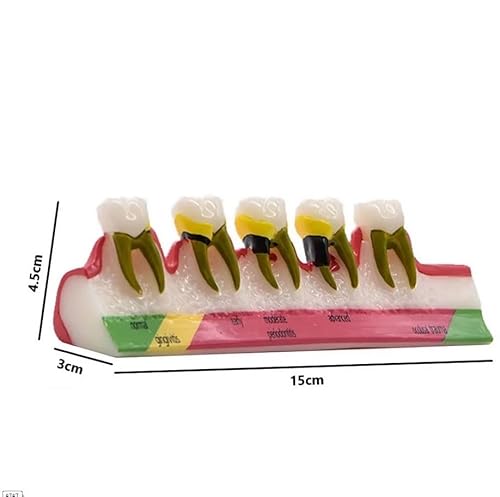 Zähne Parodontitis Modell, Zahnparodontitis Display Modell, Zähne Parodontitis Modell Verschiedene Stadien Harz Dental Parodontitis Display Modell für das Studium, Lehr