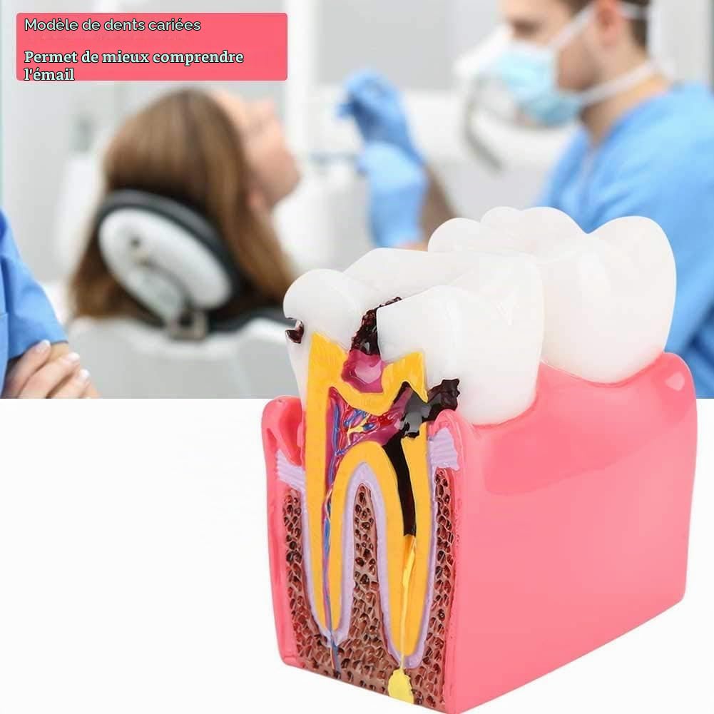 Agatige Modèle D'anatomie Dentaire, Modèles D'Étude De Comparaison De Caries Modèle De Dents D'Éducation À L'anatomie Dentaire De Dentiste Modèle De Développement De Caries Dentaires pour L'Éducation