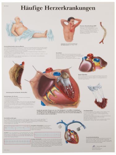 Image of 3B Scientific VR2343L Glossy UV Resistant Laminated Paper Les Maladies Cardiaques Frequentes Anatomical Chart (Common Cardiac Disorders Anatomical Chart, French), Poster Size 20 inch Width x 26 inch Height