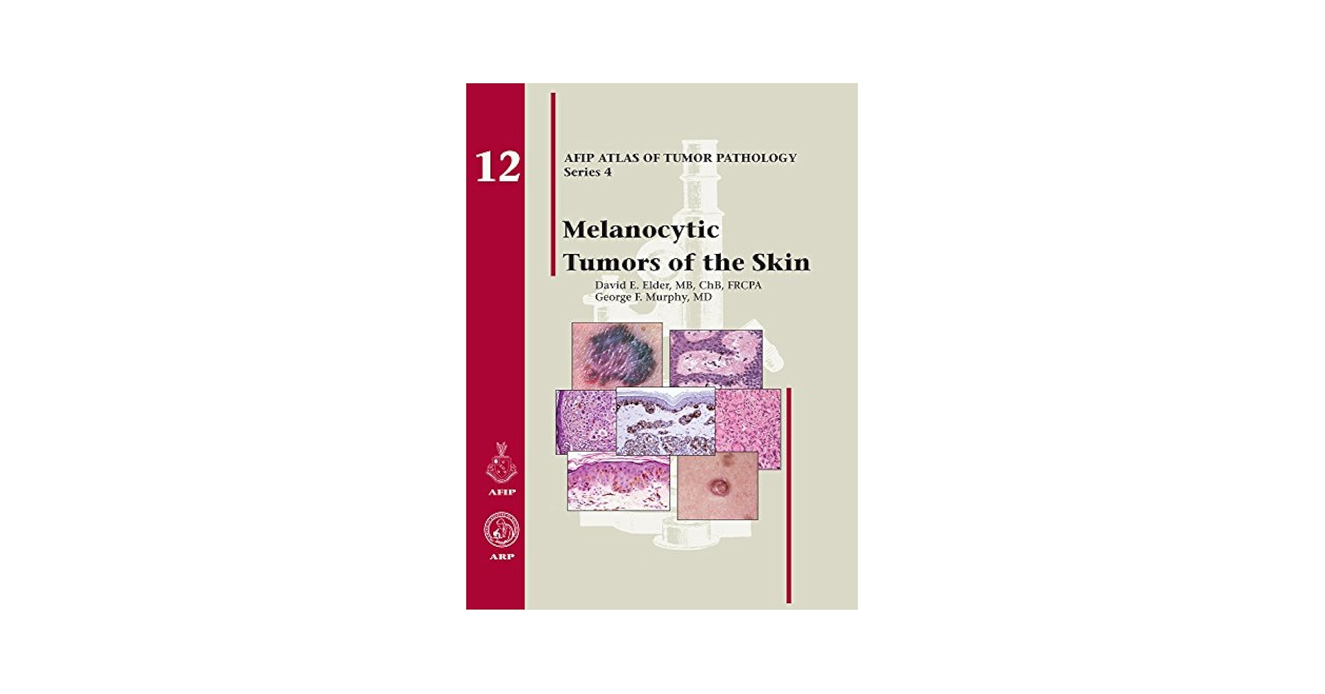 Melanocytic Tumors of the Skin (Afip Atlas of Tumor