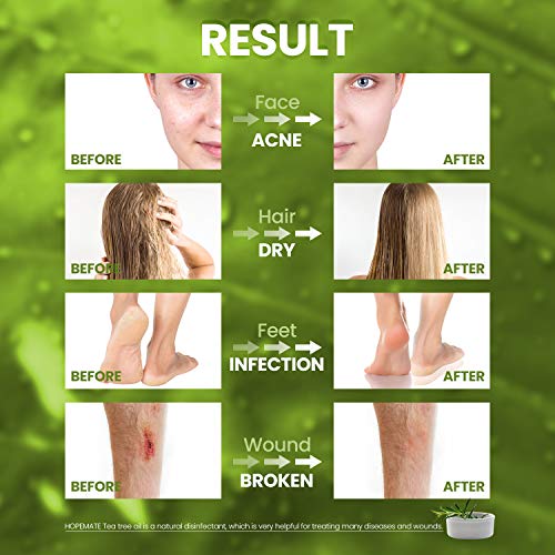 Teebaumöl 100% Reines und Naturrein, 60ML Tea Tree Oil Anti Pickel, Akne, Warzen und Andere Hautprobleme, Vegan Teebaum Ätherisches Öl für Unreine Haut, Gesicht, Kopfhaut und Haare