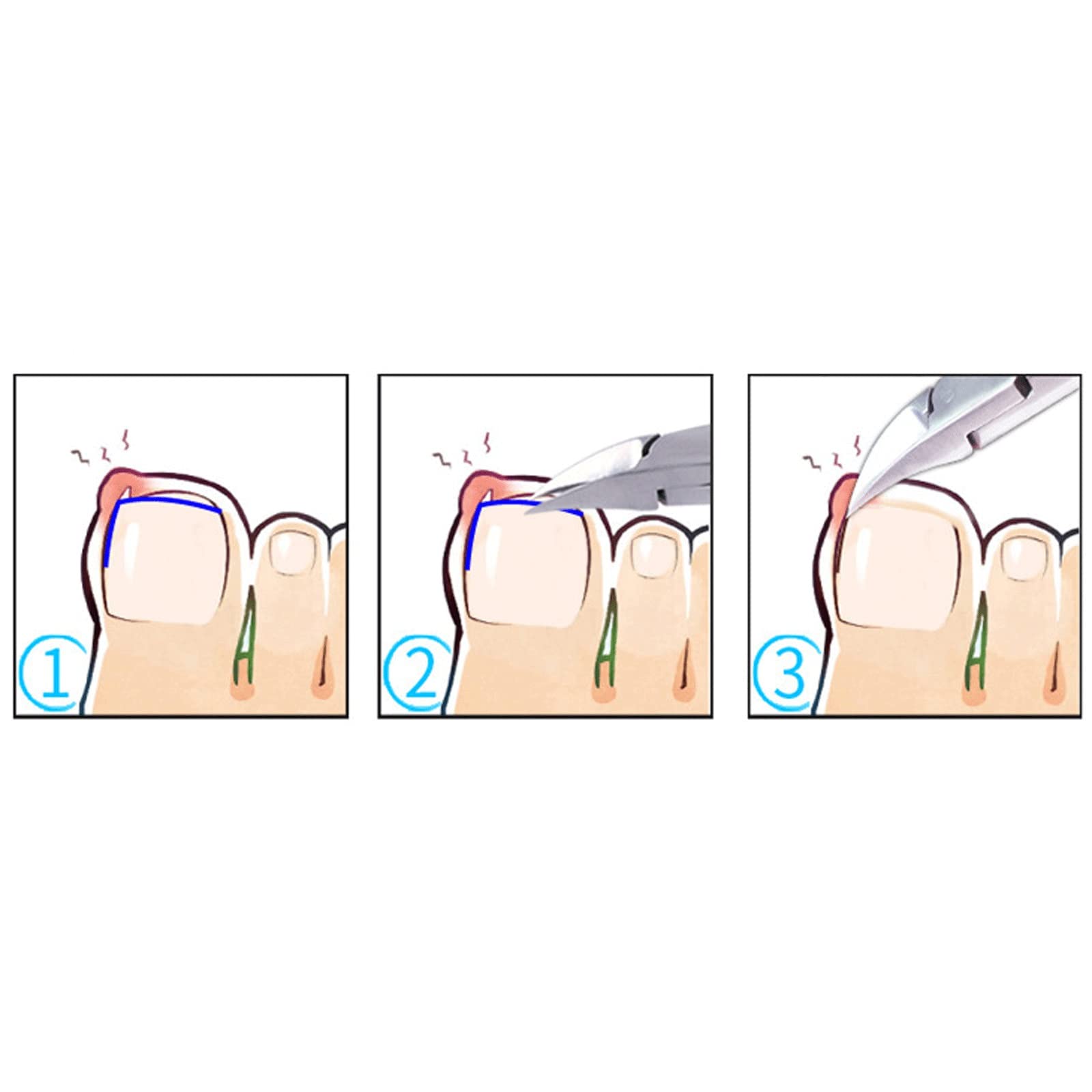 JINGYAN Obcinacz do paznokci TOE Clipper Nail do Wrastającego lub Grube Paznokcie, Paziele Trybownik Wysokiej Jakości Ze Stali Nierdzewnej Zaawansowane Tekstura Szlifowanie