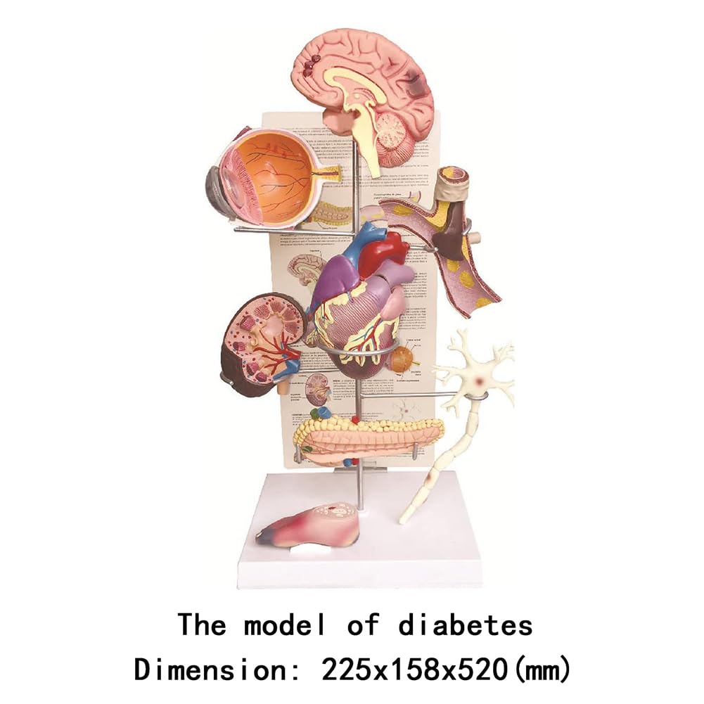 Modèle médical de diabète Modèle Anatomique de diabète Organe Humain Amovible Complications anatomiques du diabète Modèle d'affichage pour la médecine
