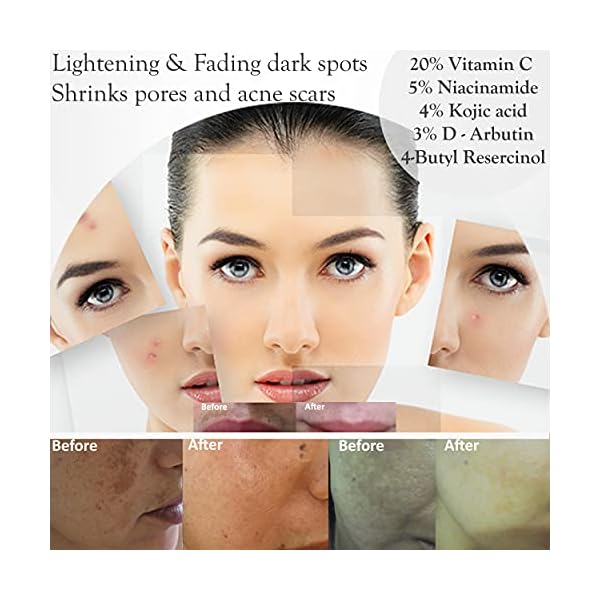 Glow-Point-Naturals-20-Natural-Vitamin-C-Serum-for-Face-with-5-Hyaluronic-Acid-5-Niacinamide-4-Kojic-Acid-Ferulic-Acid-E-B5-Skin-Lightening Glow Point Naturals, 20% Vitamin C Serum For Face With Hyaluronic Acid, 5% Niacinamide, 4% Kojic Acid, 4% D-Arbutin, VC Smart Serum