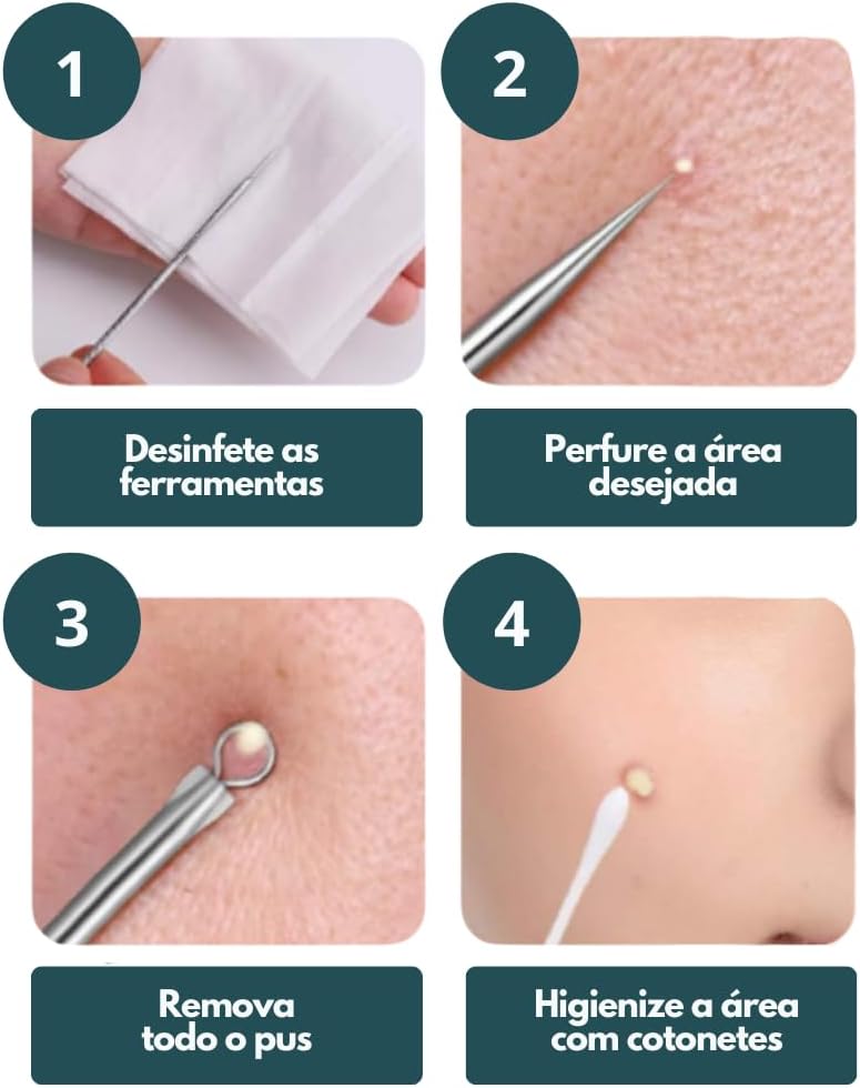 Kit Extrator de Cravos Inox Profissional 4 Peças | Removedor de Cravos e Espinhas | Ferramenta Para Limpeza de Pele Acneica | Kit Removedor de Cravos com Estojo | Premium MyBrins Kit Extrator de Cravos Inox Profissional 4 Peças | Removedor de Cravos e Espinhas | Ferramenta Para Limpeza de Pele Acneica | Kit Removedor de Cravos com Estojo | Premium MyBrins