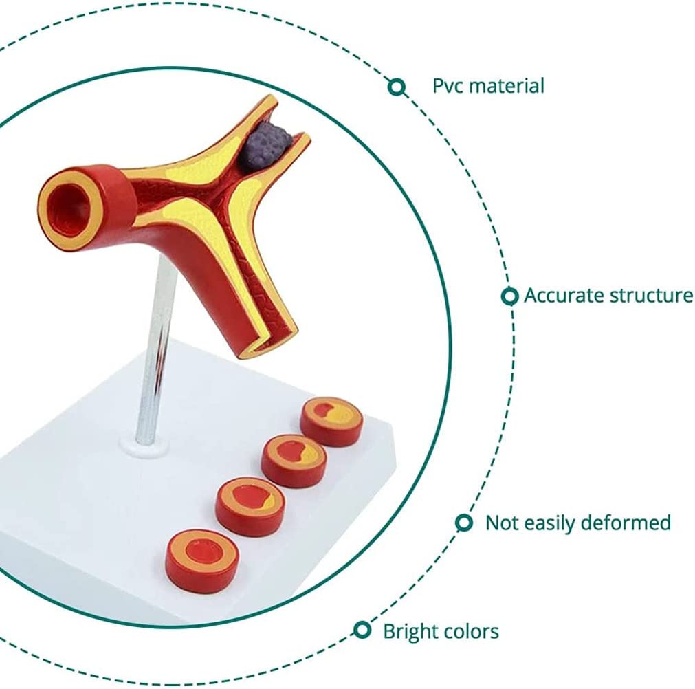 Modèle de Thrombus athéroscléreux vasculaire Humain avec Base Modèle pathologique cardiovasculaire Modèle médical Matériel pédagogique