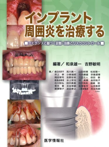 無料電子書籍 おすすめ インプラント周囲炎を治療する―エビデンスに基づく診断・治療とリスク バイ