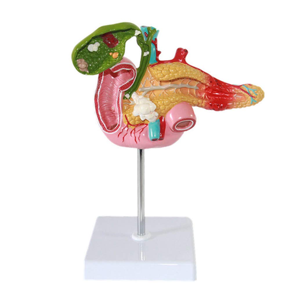 Sjdopulse Viscera Pathological Model - Pancreatic Duodenum Gallbladder Pathology Digestive System Model Human Anatomy Science Models - For Medical Educational Training Aid