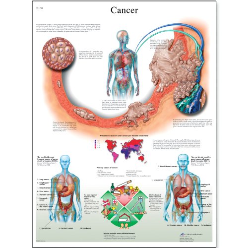 Image of 3B Scientific VR2753L Glossy UV Resistant Laminated Paper Cancer Anatomical Chart (Cancer Anatomical Chart, French), Poster Size 20 inch Width x 26 inch Height