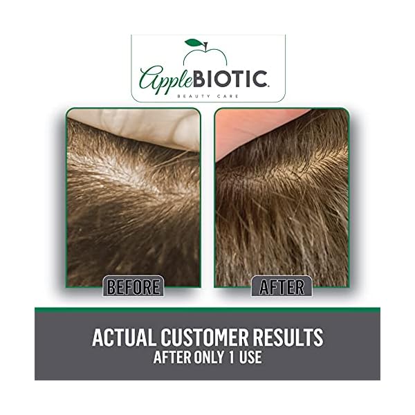 Scalp-Exfoliating-Scrub-Dry-Scalp-Treatment-Gentle-Scalp-Exfoliator-with-ACV-Moisturizes-and-Relieves-Itchy-Flaky-Skin-Hair-Scrub-Scalp-Cleanser-for-Build-Up-Healthy-Hair-Growth Applebiotic Scalp and Body Scrub - Body, Hair & Face Scrub with Sugar, Green Tea & Coconut Oil to clarify & remove product buildup, 6 oz