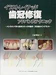 イラストレイテッド 歯冠修復 アドバンステクニック (イラスト
