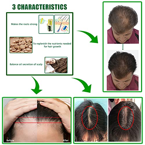 Ginger Hair Growth Serum Spray, Ginger Herb Formula Stop Hair Loss Hair Regrowth Treatments, Grow Thicker, Longer Hair, Accelerate Hair Growth For Man And Woman (1Pcs) #TOP2