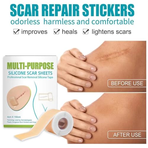 Image of VELOMIX Multipurpose Silicone Scar Sheets, Silicon gel sheets for Scars,Silicone Gel Tape for Scar Removal, Professional Scar Removal Sheets for C-Section, Surgery, Burn Protein (pack of 1)