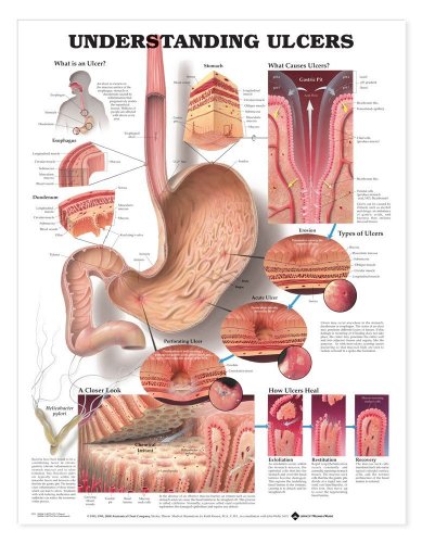 Poster éducatif sur les ulcères : solution visuelle pour simplifier l'anatomie - 2