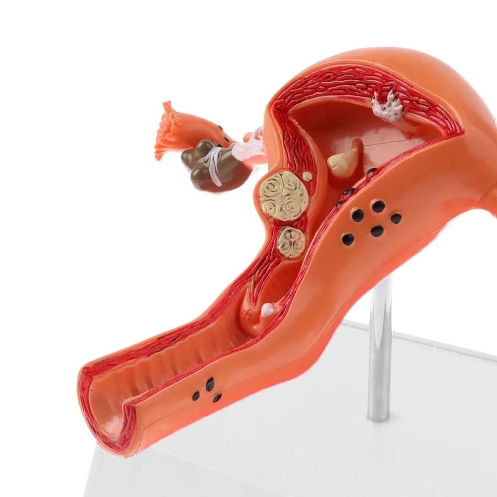 Human Pathological Uterus Ovary Model Cross Section Structure Model Uterus Anatomical Model Anatomy Female Organ Study Tool