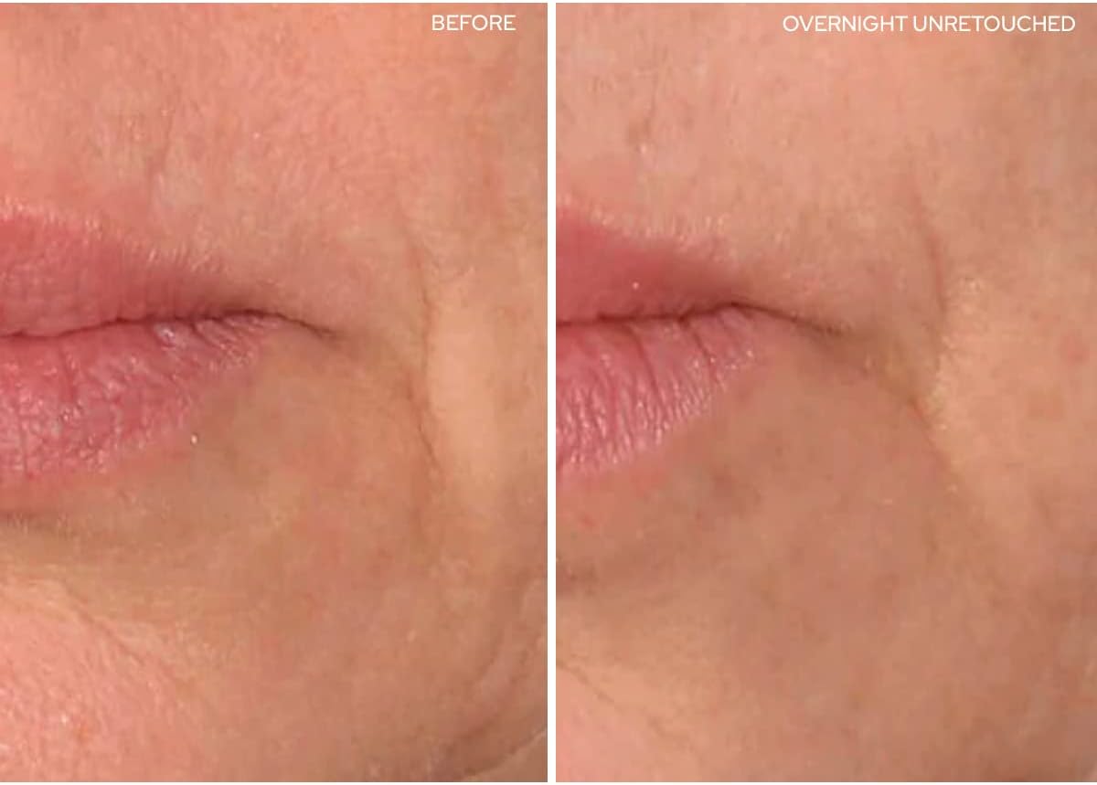 Revitalize Your Smile: SiO Beauty Super LipLift Patches Review