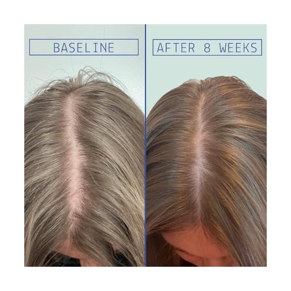 AAVRANI Hair Density Boosting Treatment - Ashwagandha, Vegan Collagen, And Turmeric Scalp Serum For Thicker, Fuller Hair - Vegan, Non-Greasy - 2 Fl Oz