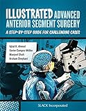  Illustrated Advanced Anterior Segment Surgery: A Step-by-Step Guide for Challenging Cases