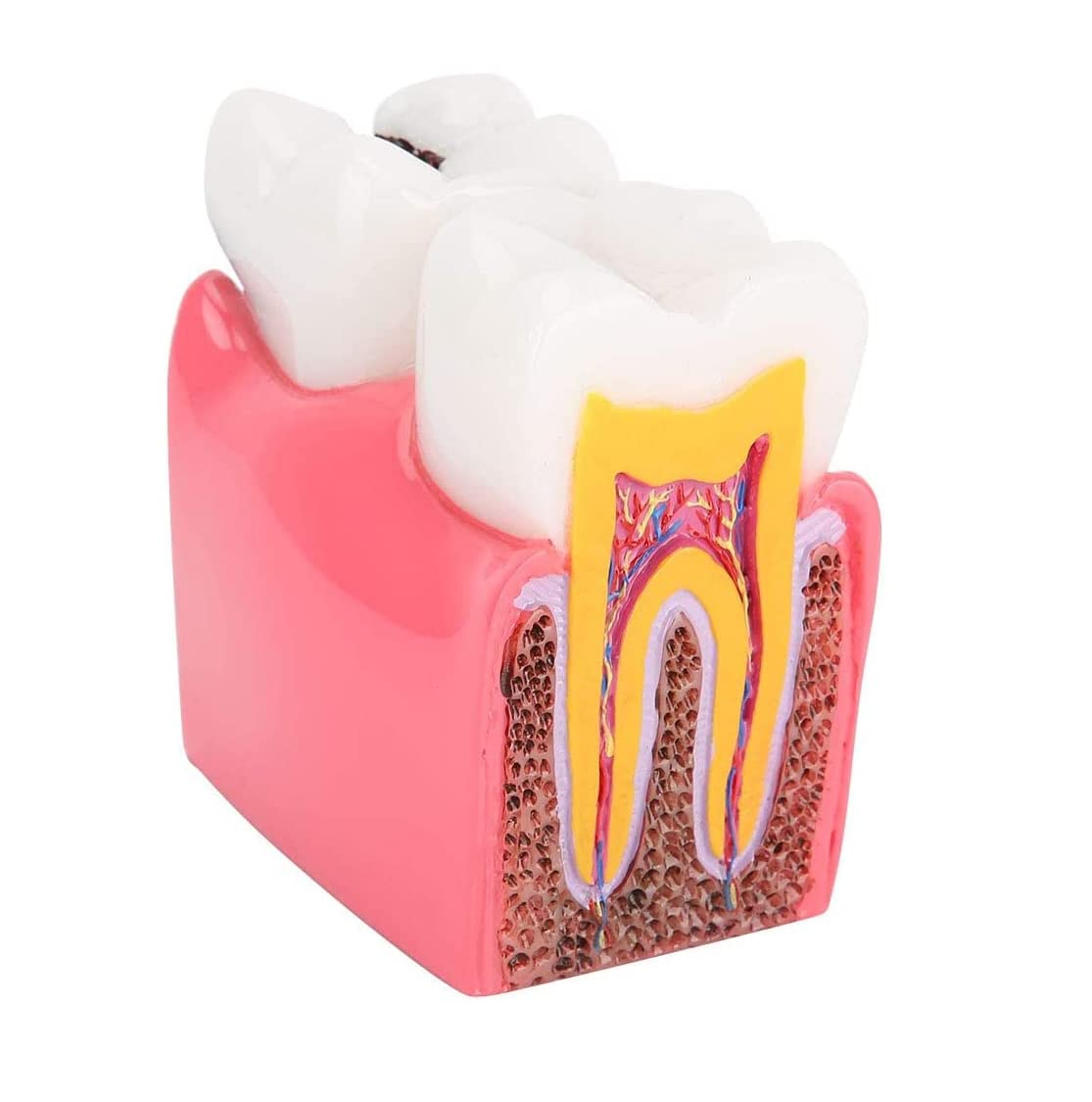 Modelo de Dientes dentales Resina Caries Estudio de comparación Modelo de sección Transversal de Dientes Anatomía Dentista Educación Dental Modelo para Estudios dentales