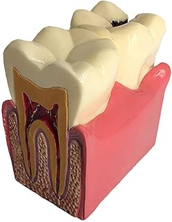 DFES Tooth Model, 6 Times Caries Contrast Model Oral Dental Anatomy Demonstration Teaching Model, is an Ideal Model for Dental Patients