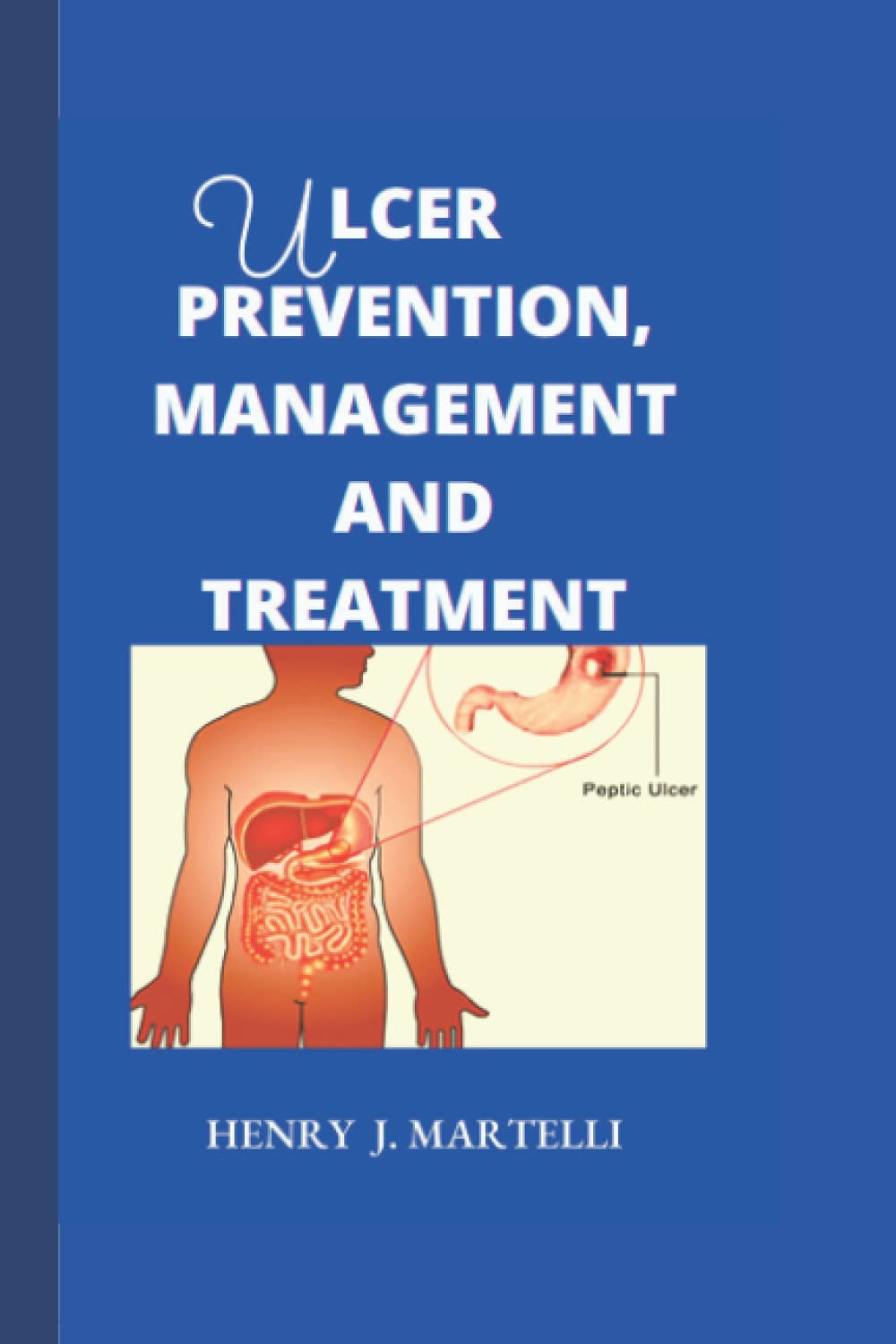 Ulcer prevention, management and Treatment: Ulcer free