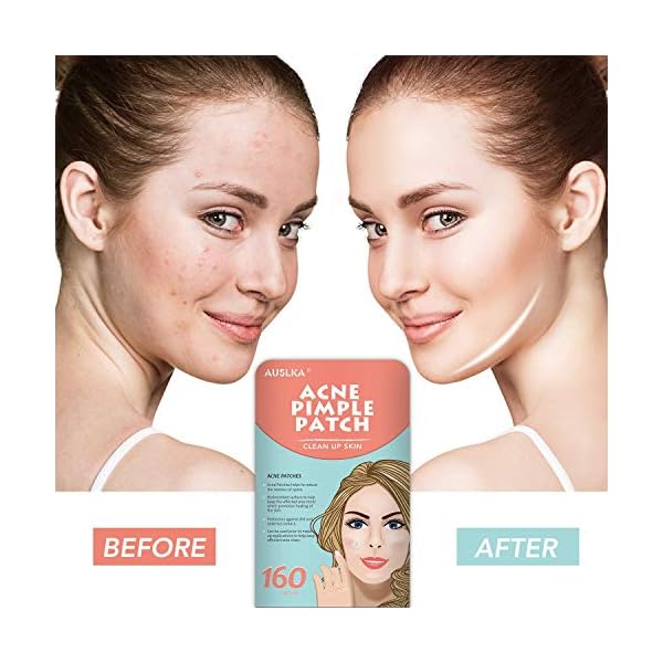 AUSLKA-160-PatchBlemish-Pimple-Patches-Zit-Stickers-Blemish-Spot-Patch-Hydrocolloid-Blemish-Dots-for-Face AUSLKA (160 Patch) Acne Pimple Patches, Zit Stickers, Blemish Spot Patch, Hydrocolloid Acne Pimple Patch for Face Zit…