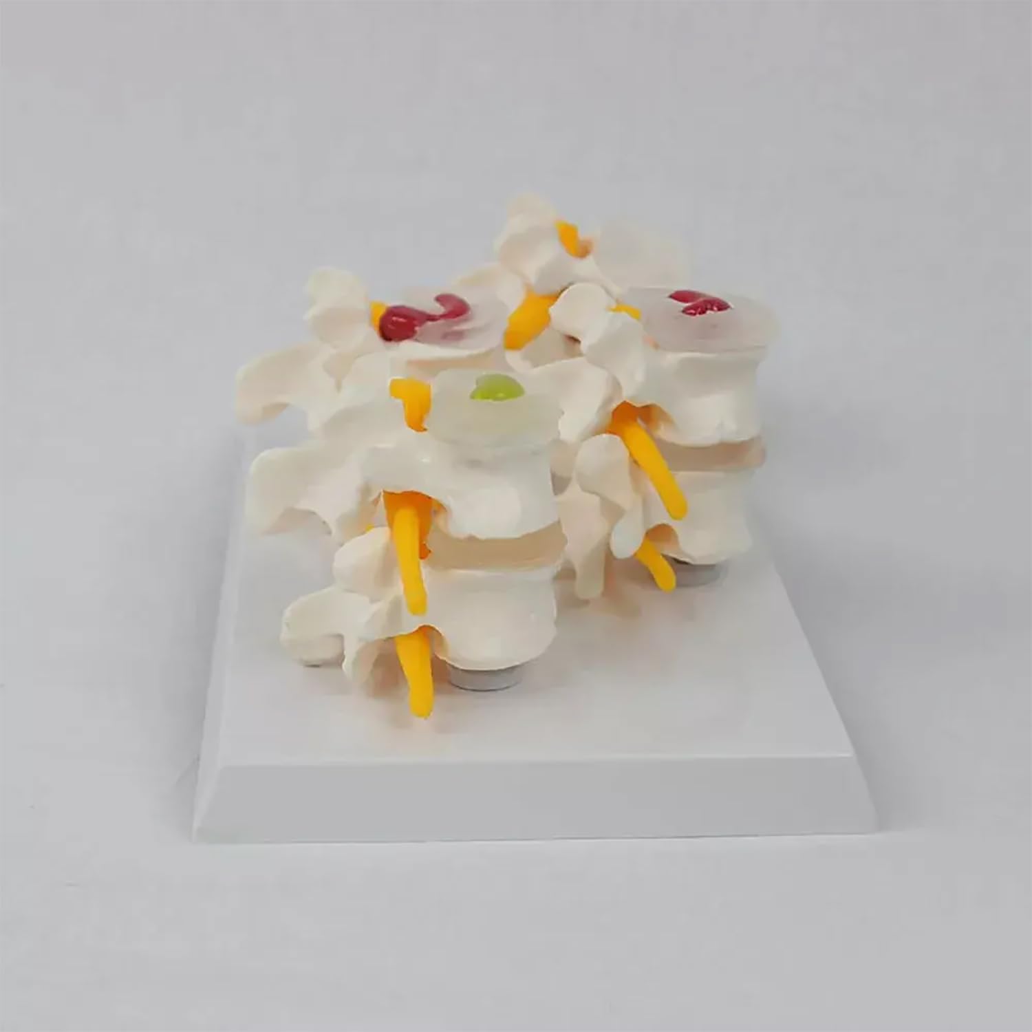 Modelo De Hernia Discal Humana, Modelo De Columna Vertebral Humana, Diseño Detalles Realistas Y Texturas Claras, Mano De Obra Fina Y Soporte Reutilizable, Para La Enseñanza Anatomía Del Esqueleto