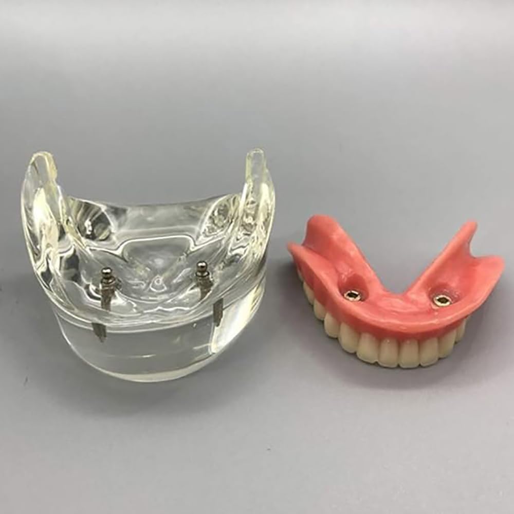 Modelo Dental - Modelo de Dientes de Implantes Dentales- Sobredentadura Dental Mandibular Inferior 2 Implantes Demo para Enseñar y Estudiar