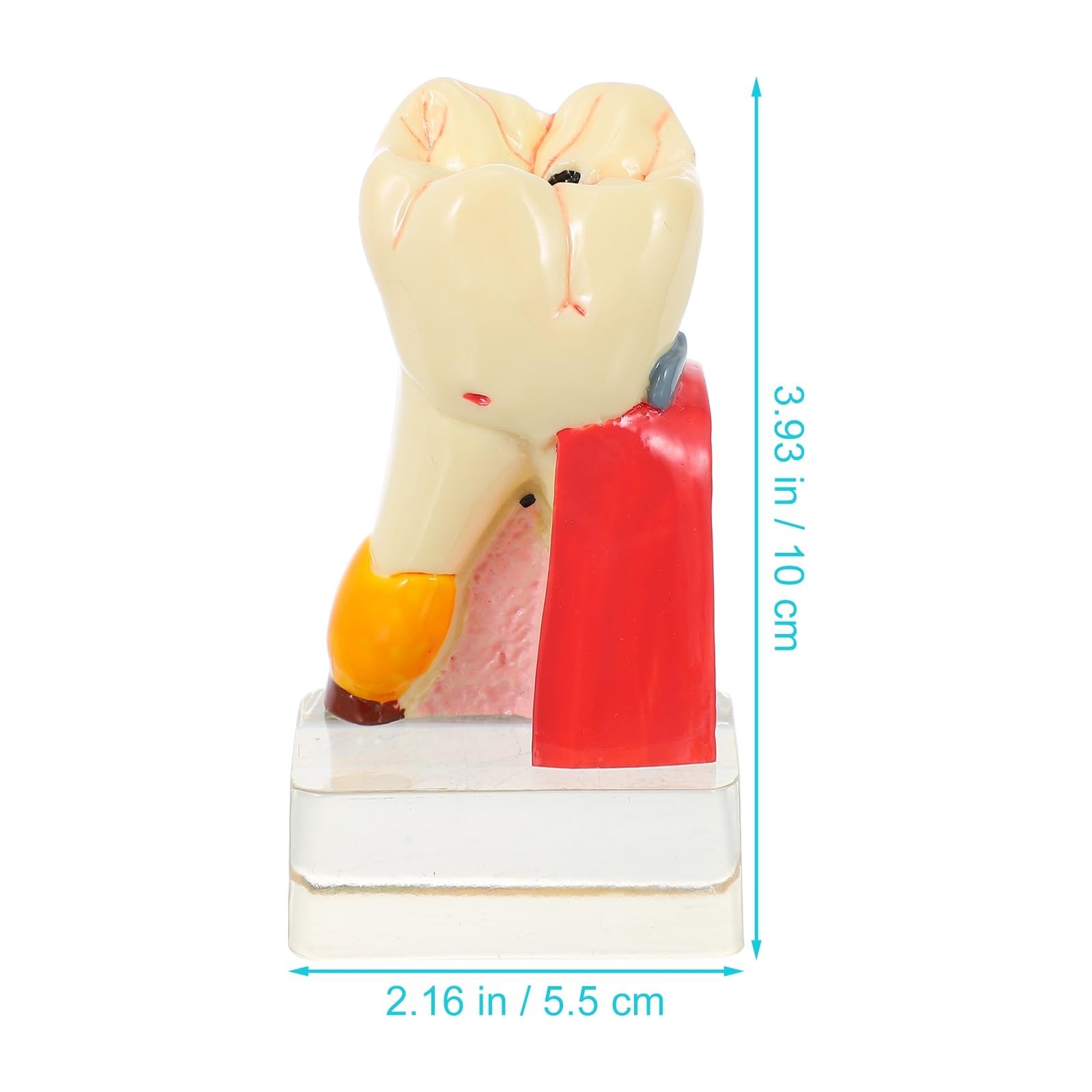 Zerodeko Modèle Anatomique de Carie Dentaire Beige en Résine Portable pour Démonstration Professionnelle des Soins Dentaires par Dentistes