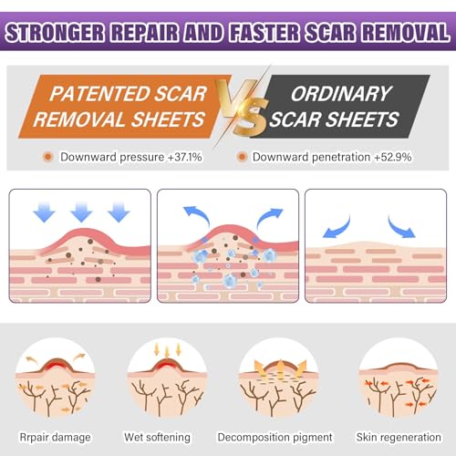 Image of Medical Grade Silicone Scar Tape Scar Sheet,Scar Strips,Scar Remover,C-Section, Surgery, Keloid, Tummy Tuck, Scar Patch (1.6 inchX 60 inch 4cmx1.5m)