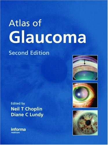 Amazon | Atlas of Glaucoma | Choplin, Neil T., Lundy, Diane C