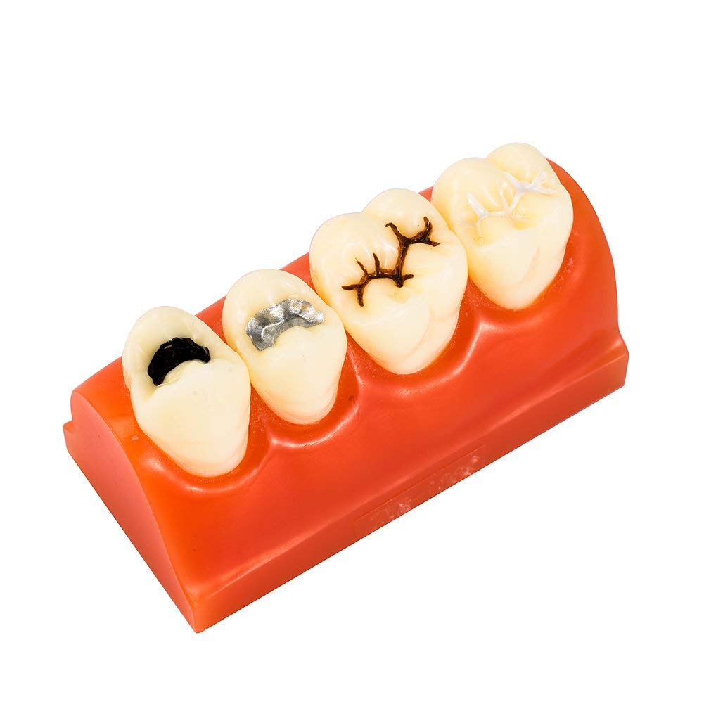 Modello di denti dentali per allenamento orale, chiusura a fessura e scanalatura, strumento educativo per anatomia umana, studio medico e simulatore di pratica