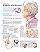 Understanding Alzheimer's Disease Anatomical Chart