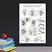 Palace Learning Laminated Anatomy and Injuries of the Hand and Wrist Poster - Hand and Wrist Joint Anatomical Chart - 18