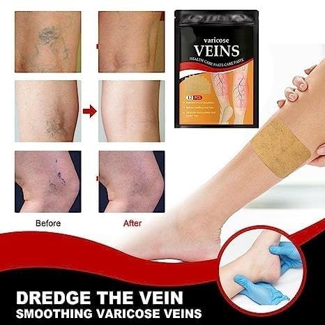 Varicose Veins Patches Dredge Vein Smoothing Veins Reduce Swelling Relieve Pain Instant Relief from Muscular Pain Improve Blood Circulation (1) Varicose Veins Patches Dredge Vein Smoothing Veins Reduce Swelling Relieve Pain Instant Relief from Muscular Pain Improve Blood Circulation (1)