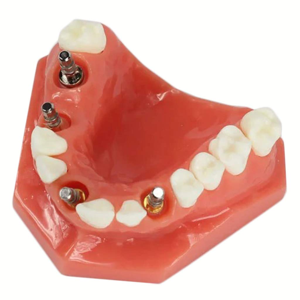 Sjdopulse Dental Implant Model Dentist Implant Demonstration Model - Dental Teeth Model Teeth Study Teaching Model - For Study Display Teaching Medical Model