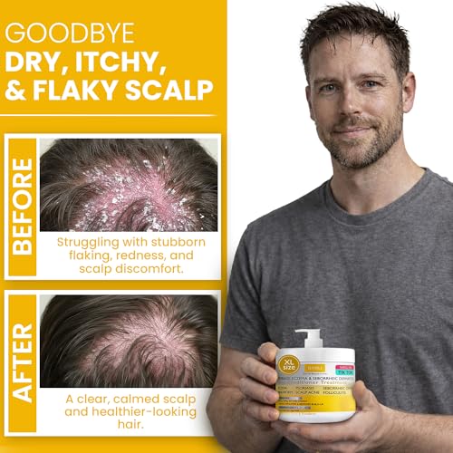 Image of Anti Fungal Psoriasis Conditioner for Psoriasis, Eczema & Seborrheic Dermatitis | with DHT Blockers, Mineral Complex & Tea Tree Oil | Soothes Dry Itchy Scalp & Supports Hair Growth for Men & Women