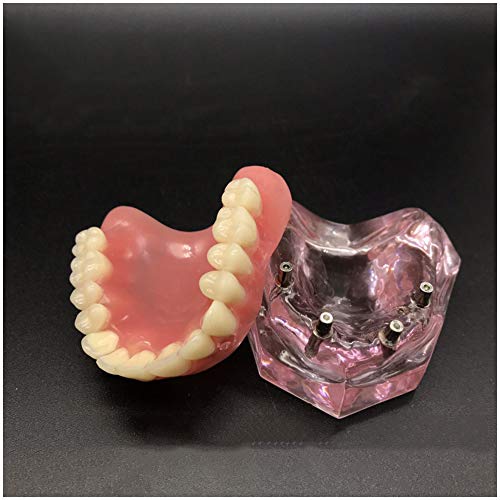 LUCKFY Dental Model – Transparent Implant Teeth Set LUCKFY Dental Model – Transparent Implant Teeth Set