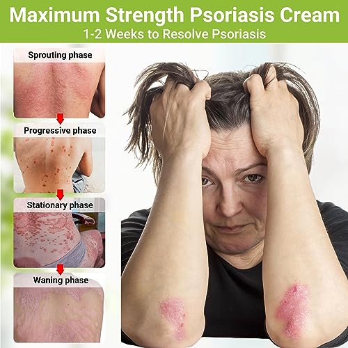 LMNOOP Psoriasis Cream, Maximum Strength Treatment Moisturizing Cream for Psoriasis, Dermatitis, Rash, Anti-Itch, Redness, Flaking, Scaling, Fast Acting Relief for Irritated, Dry Skin