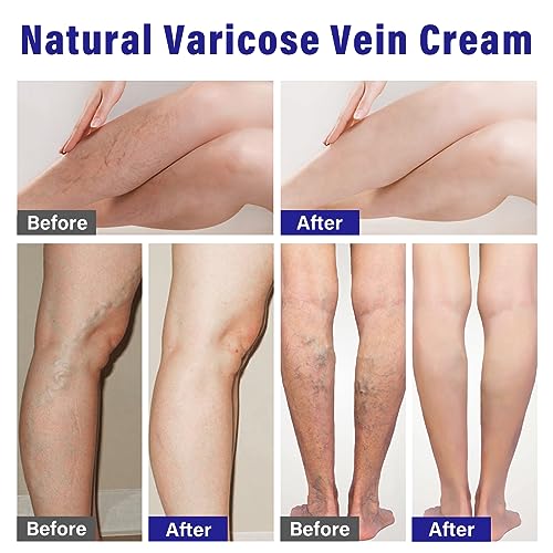 Sovob Varicose Veins Treatment For Legs, Varicose Veins Cream Natural Treatment For Improve Blood Circulation Relieve Leg Swelling & Fatigue Relief thumb #4
