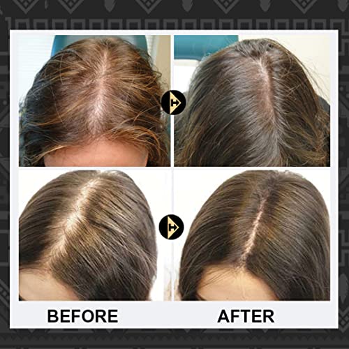 Rice Water For Hair Growth,Fermented Rice Water Hair Growth Spray Contains Biotin&Caffeine For Hair Loss And Thinning Hair -- With Rosemary Oil For Hair Growth ,Effective Hair Regrowth And Thickening. #TOP4
